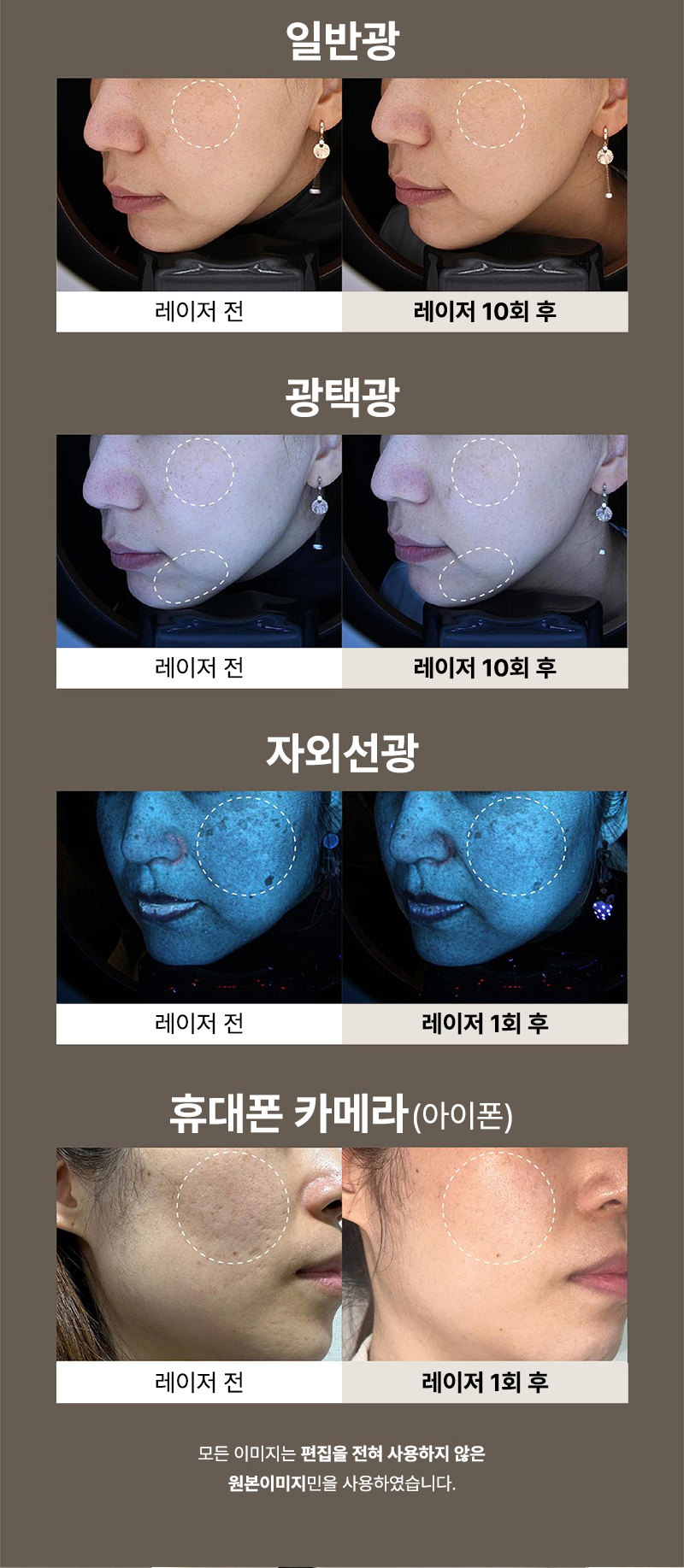 몬스터의원 단독특가★ 실리프팅 짱짱하게 리프팅 이벤트, 시술 상세 이미지