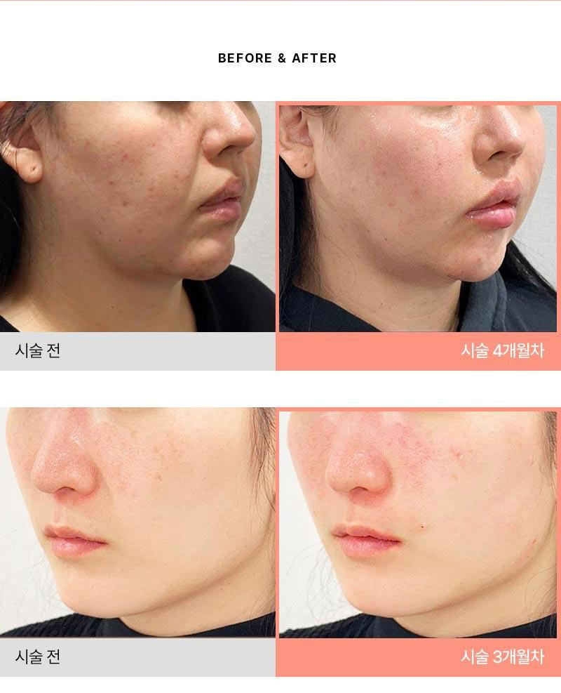 몬스터의원 쥬베룩 5CC 쥬베룩볼륨 이벤트, 시술 상세 이미지