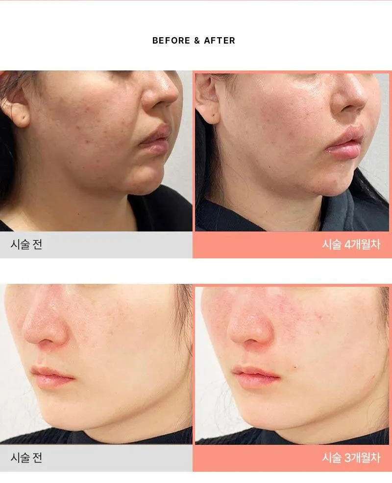 몬스터의원 쥬베룩 5CC 쥬베룩볼륨 이벤트, 시술 상세 이미지