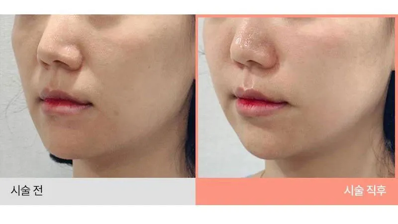 몬스터의원 쥬베룩 5CC 쥬베룩볼륨 이벤트, 시술 상세 이미지