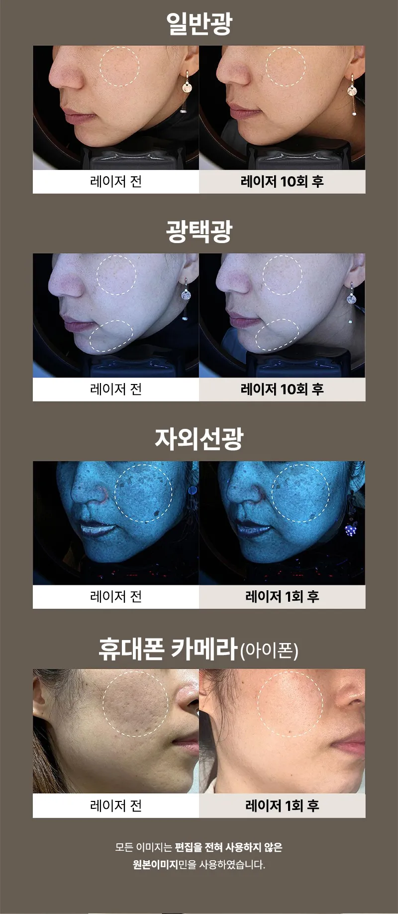 몬스터의원 양측포함 바디 인모드 FX  이벤트, 시술 상세 이미지