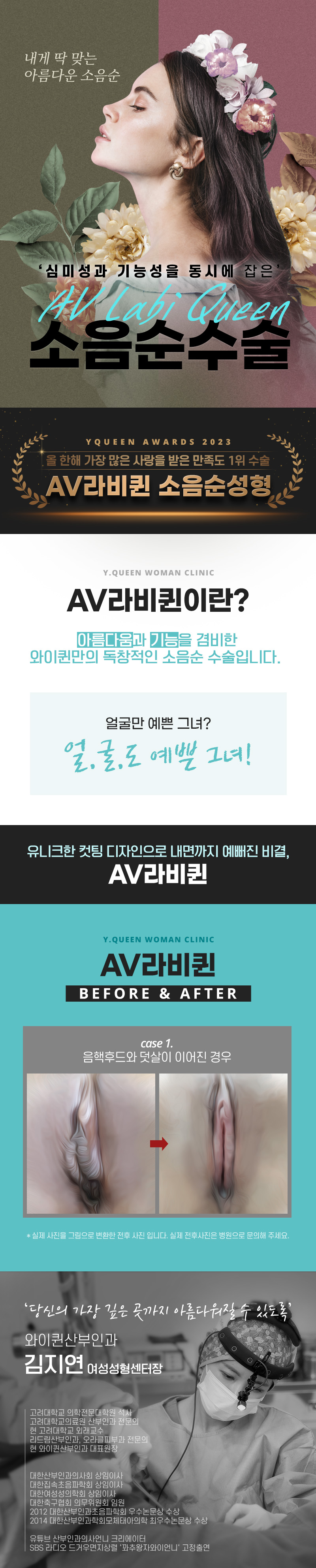 와이퀸산부인과의원 소음순수술 내게 '딱'맞는 디자인으로 이벤트, 시술 상세 이미지