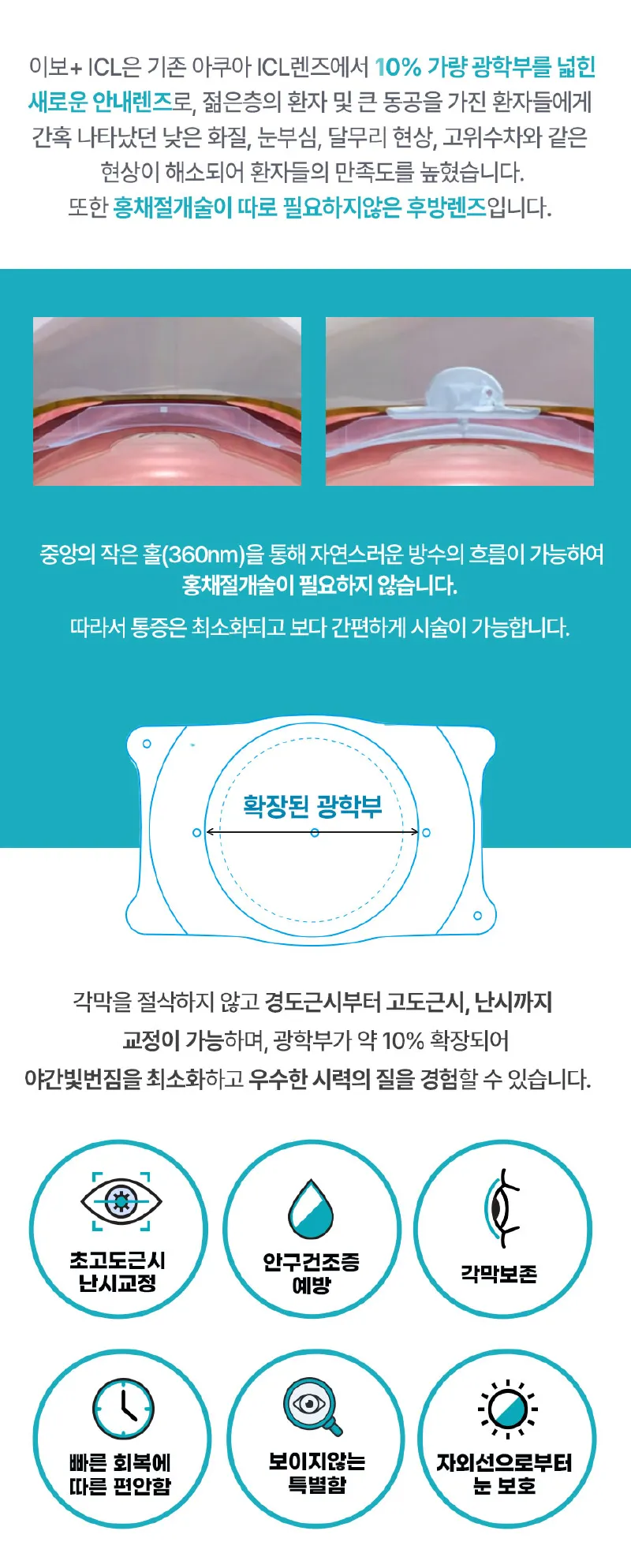 밝음나눔안과 강남점 밝음나눔 렌즈삽입술 ICL 이벤트, 시술 상세 이미지