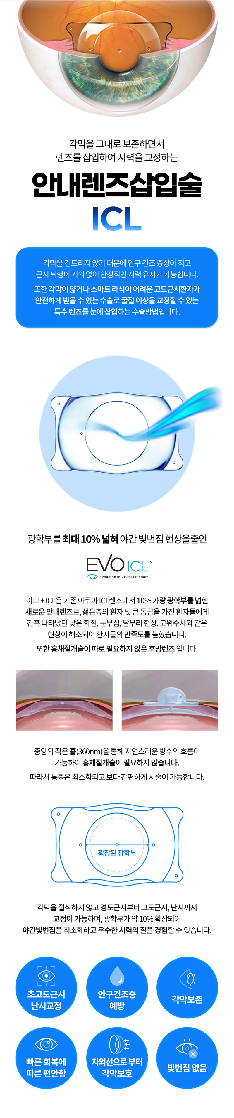 밝음나눔안과 강남점 밝음나눔 렌즈삽입술 ICL 이벤트, 시술 상세 이미지