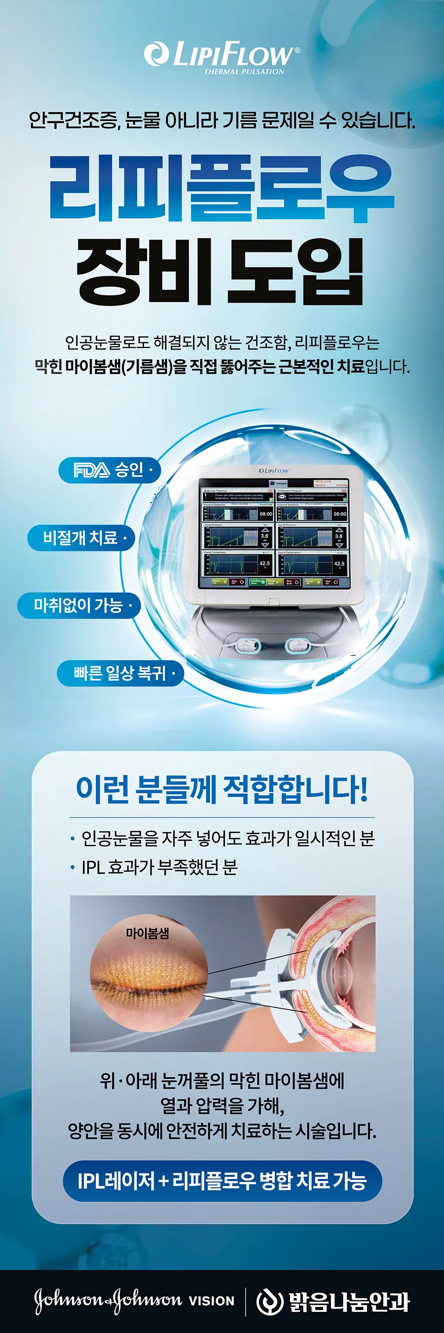 안구건조증 IPL 옵티라이트