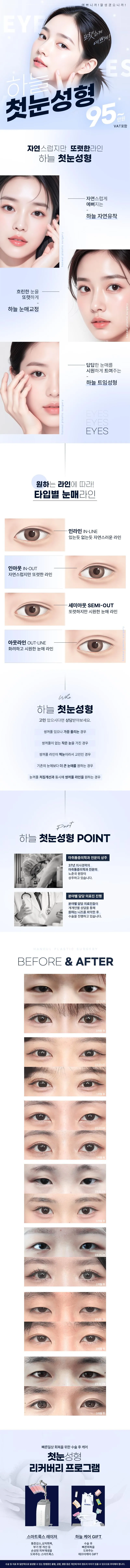 하늘성형외과의원 하늘 눈성형 이벤트, 시술 상세 이미지