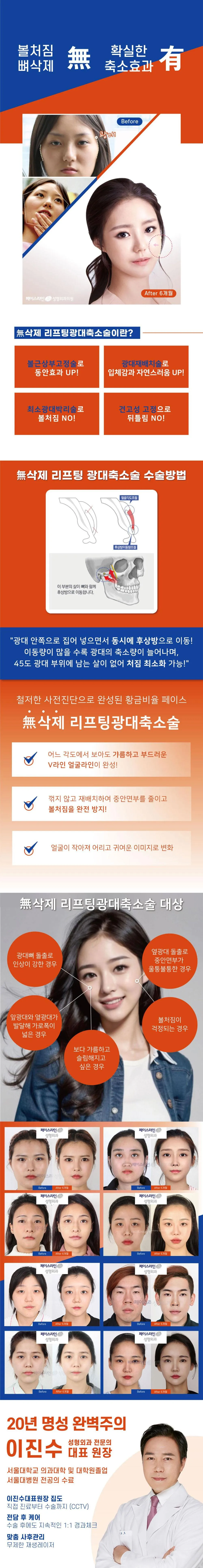 페이스라인성형외과의원 무삭제리프팅광대축소술 이벤트, 시술 상세 이미지